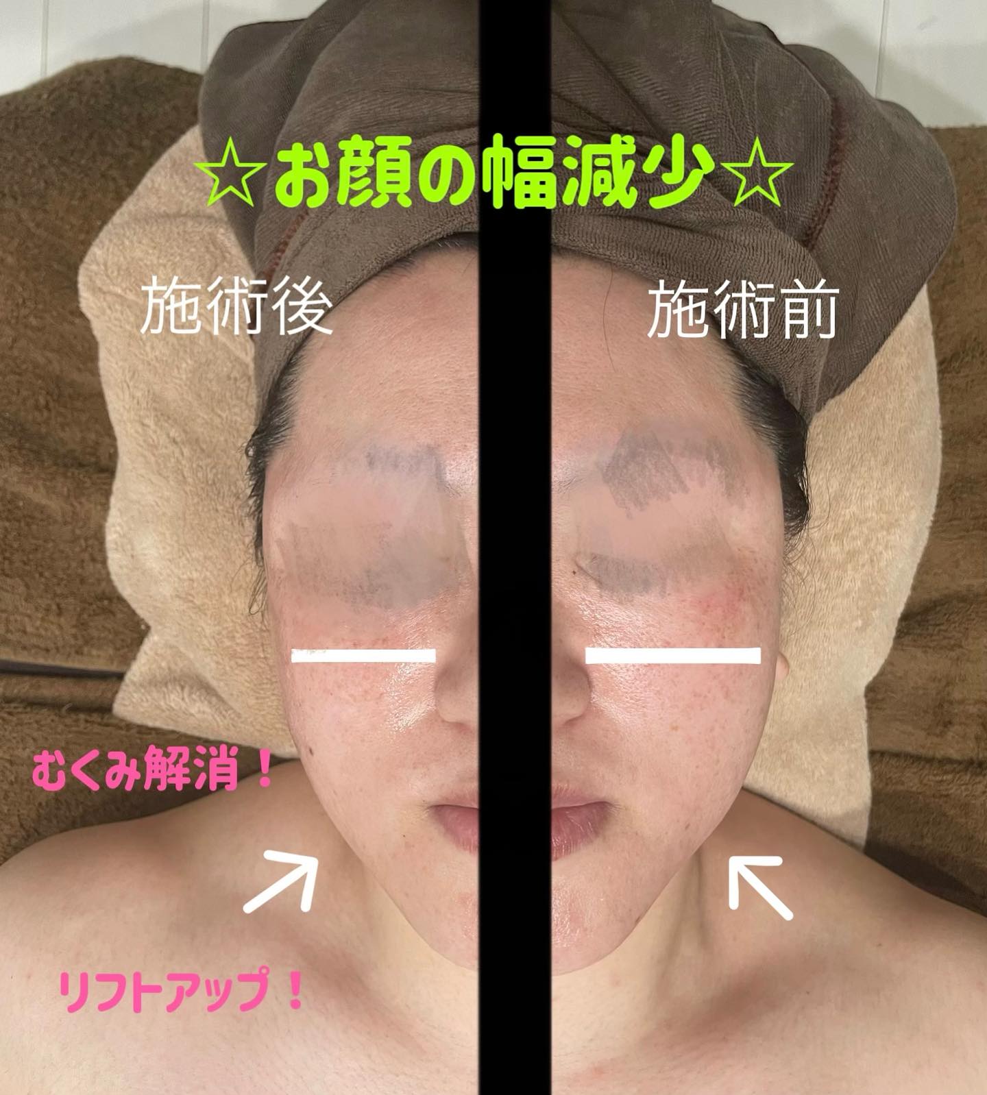 当店No.1人気(女性) 60分フェイシャルコース
ご新規様 Instagramフォロー&DM予約で ¥5000
※各DTインディバケアにも勿論対応してます※インディバってなに??
どんな効果があるの??美容と健康、全てのケアが可能なのがインディバです。
全身こりはりにも、ダイエットにも、冷え性にも、各DTケアにも、自律神経の整えにも、美肌美白ケアにも、細胞レベルからのアンチエイジングケアも。
心と身体の全てをケア出来て、
尚且つ、暖かくて気持ちがいい。長年、エステ業界に携わり、最新のマシンに触れ、施術を受けて来たわたしですが、これほど気持ちが良くて効果が実感できるマシンはないです。
あくまで個人的な意見にはなってしまいますが…笑生きている以上、一度は受けてほしいインディバ。
いい物だという自信があるからこそ、
「ハードルは低く、クオリティーは高く」を、モットーに
1人でも多くの方に、体験して欲しい。どなた様もお気軽にお問合せ下さい🙇♀️🙇♀️🙇♀️インディバの偽物、通電クリームの偽物を使用しているサロンが大変多くなっております。
ご注意下さい⚠️当店はインディバジャパン公認サロン、完全正規通電クリーム使用店です。
ご安心下さい🙇♀️🙇♀️🙇♀️#痩身#インディバ #DT #温活 #体質改善 #リラクゼーション #血流促進 #ボディメイク #ボディメンテナンス #疲労回復 #自律神経 #アンチエイジング #肩こり #腰痛 #代謝up #眼精疲労 #ダイエ ット #くびれ#小顔 #ダイエット #ブライダル#リフトアップ #美容 #エステ #美肌 #エステサロン #フェイシャルエステ #ボディエステ #むくみ