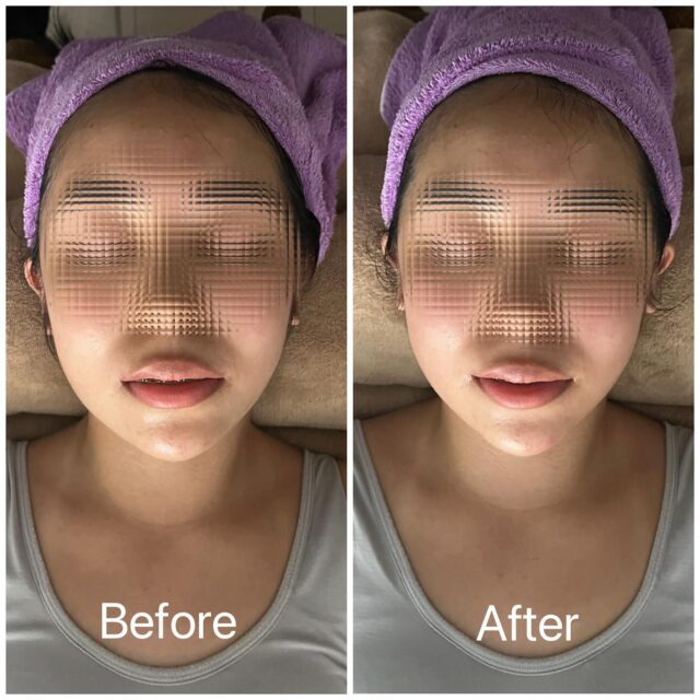 当店不動の1番人気メニュー
60分インディバフェイシャル。各DTケアは勿論のこと
小顔改善、くいしばりケア、ほうれい線対策、眼精疲労、視界不良、偏頭痛改善、首･肩こり、ヒアルロン酸･ボトックス効果減少希望の方も。どんな些細なことでも構いません。
1人で悩まず、まずはNiCOまでお問い合わせ下さい🙇‍♀️一緒にお悩み解決していきましょう🎵#インディバ
#お悩み相談
#小顔
#くいしばり
#エステ
#トータルケア
#美容
#健康
#メンタル
#セラピスト
#偏頭痛
#眼精疲労
#シミ、シワ改善
#蕨駅
#自分らしく
#ドレナージュ