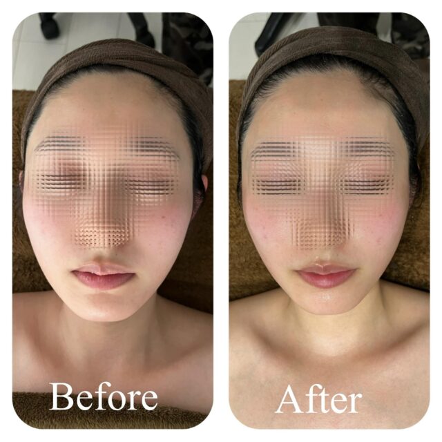 ご新規様限定90分¥8.000
お時間内であれば、ボディー＆フェイシャル
マシン組み合わせ自由のフルコースメニュー！！！1度でここまで劇的に変化して頂くことが出来ます。
※効果には個人差があります※撮影前、デート前、各美容整形後ダウンタイムケア、むくみ、コリハリ、代謝アップ、ダイエットなどなどお客様のご要望をしっかりお聞きした上で、安心して施術を受けて頂けるように努めております。どんな些細なことでも構いませんので、なんなりと仰ってください。一緒に楽しく、極上のリラックスタイムをお過ごし下さい！#インディバ
#DTケア
#エレクトロポレーション導入
#代謝アップ
#ダイエット
#メンテナンス
#埼玉
#川口市