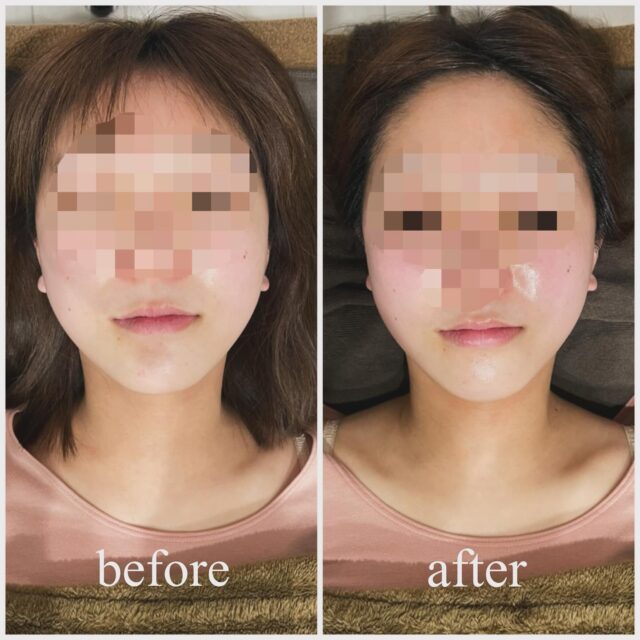 お写真のご協力ありがとうございます！インディバ＋ドテラオイルドレナージュ＋ETP導入 60分
ヒト幹細胞、プラセンタ、ビタミン、ヒアルロン酸etc
お肌のお悩みに合わせ、美容液を複数混ぜ合わせてから
導入していきます。インディバでむくみを取りトーンを上げ
ドテラオイルでお肌を整えドレナージュ
ETP導入で美容液を皮下組織にまで浸透させます。
1度のケアで、ここまで変わります！当店はDTケアはもちろんの事、
お客様の日頃のメンテナンスにもご利用いただけます。月に1度のご褒美にｯｯ
月に2度の根本からのメンテナンスにｯｯ
月に3度以上の心と体、セルフケアを学びにｯｯどんな目的でご利用のお客様にも、全力でお応え出来るよう
インディバサロンとは思えない程の価格設定で
皆様をお待ちしております！！！どんなお悩みをお持ちの方も、1人で悩まずお気軽にご相談下さい。