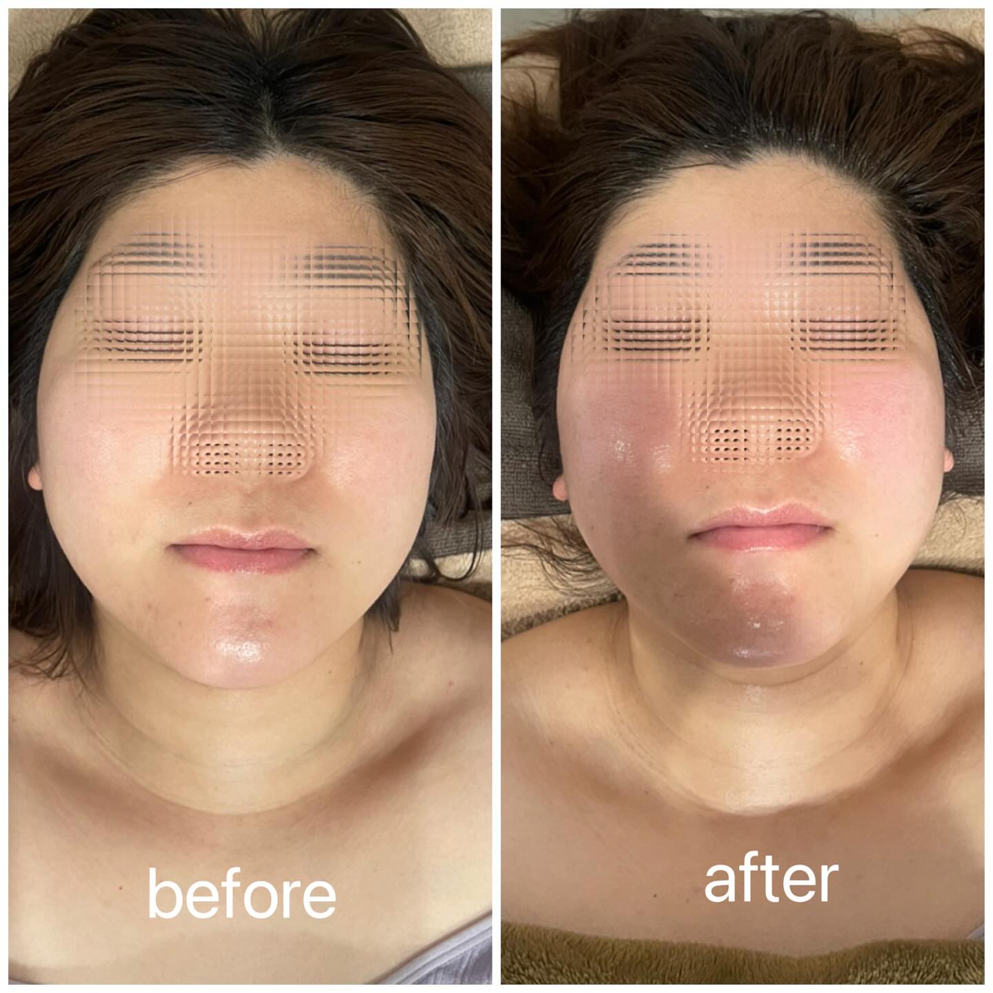 ご来店、お写真のご協力ありがとうございます。
エステ初体験の方の人気施術NO1施術は
インディバ+オイルドレナージュ60分 です!!インディバの細胞レベルからのアンチエイジング効果
むくみ、たるみケア、デコルテ肩こりケア、血行促進、小顔効果
様々な効果が期待でき、仕上げにdoTERRAオイルを使用した
ドレナージュでリンパの流れを良くしていきます。当店は回数券、物販を元々ご用意しておらず
エステサロンでありがちな、押し売りや物販購入を求める行為は
一切行っておりません。なぜなら、それをしなくてもまた来たいと思っていただけるサロンを徹底的に心がけているからです。
価格設定に始まり、コミュニケーション、お客様のお悩み・相談のリスニング、なりたい自分を教えて頂く。そしてわたしは
出来る限りの知識と施術でお応えする。セラピストとして独立し、わたしが目指しているセラピストを追求実行してから、何より大切にしてきた事です。
それが結果となり、去年までリピート率97.4%でしたが
今年に入ってから、リピート率がほぼ99%になりました!!今年もまた新しい自分、新しい施術、新しいマシンを増やし
お客様、私に関わる全ての方への恩返し、喜んで頂けるサロンを目指し、日々進化していきます。#インディバ
#小顔効果
#ドレナージュ
#くいしばり
#血行促進
#doTERRA
#ETP導入
#肩こり
#美容整形
#ダウンタイム
#DTケア
#蕨
#川口
#ダイエット
#脂肪吸引
#メンタルケア
#学べるサロン
#自分らしく
#エステ初心者
#完全個室サロン
#DTケア講師
#ダウンタイム
#美容整形
#美容と健康
#自律神経
#お悩み相談
#自然派サロン
#薬に頼りすぎない
#根本改善